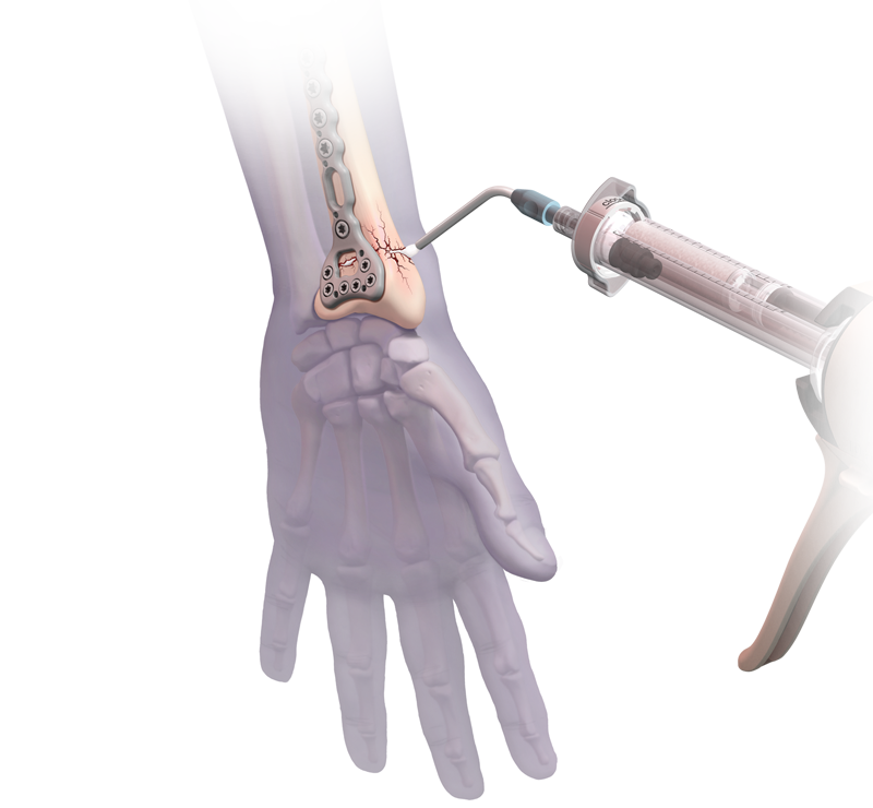 Calcium Phosphate Bone Cement Market Revenue, Trends, and Strategic Insights by 2032 2 Calcium Phosphate Bone Cement Market