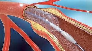 Intracranial Stenosis Stents Market