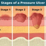 Pressure Ulcers Treatment Market