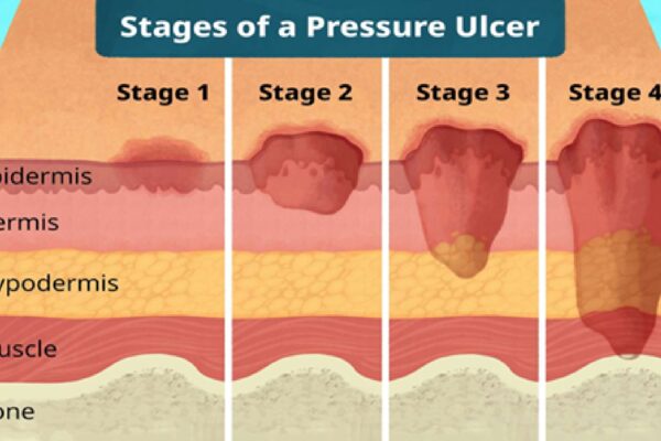 Pressure Ulcers Treatment Market