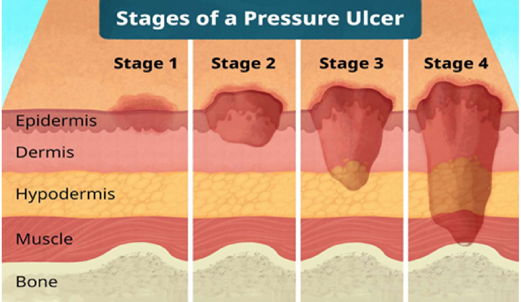 Pressure Ulcers Treatment Market