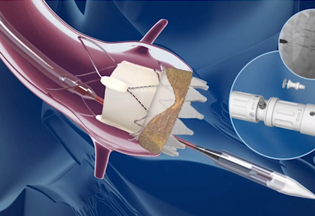 Interventional Cardiology Devices Market