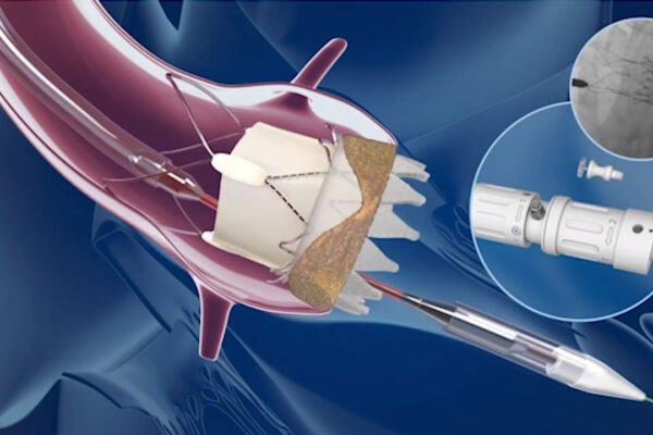 Interventional Cardiology Devices Market