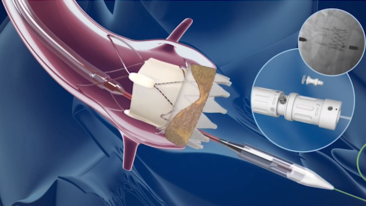 Interventional Cardiology Devices Market