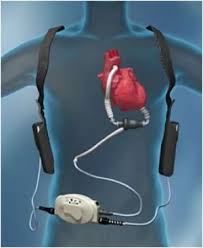 Heart Pump Device Market