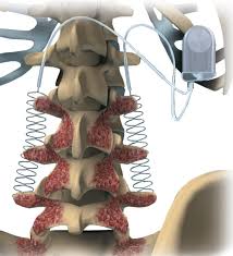 Bone Growth Stimulators Market Revenue, Trends, and Strategic Insights by 2035 1 Bone Growth Stimulators Market
